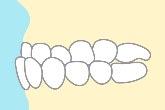 下顎前突（受け口）