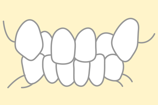 叢生（乱ぐい歯）