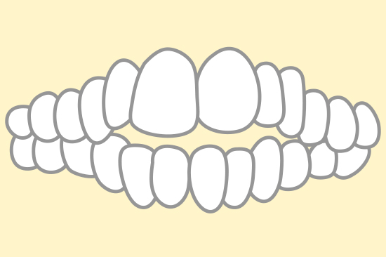 開咬（オープンバイト）