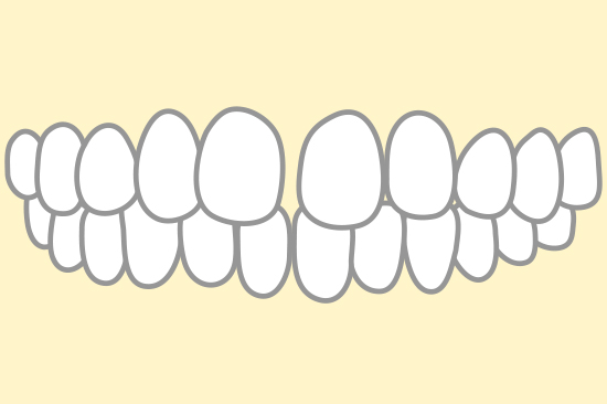 空隙歯列（すきっ歯）